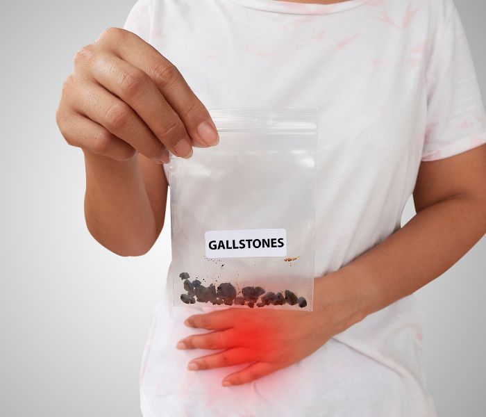 Gallstones